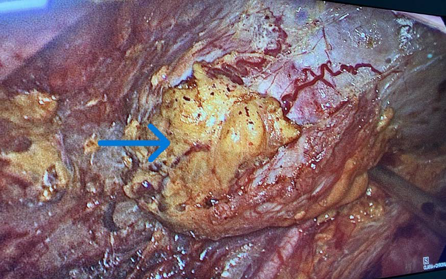 A tumor in the lower pole of the right kidney (green arrow).